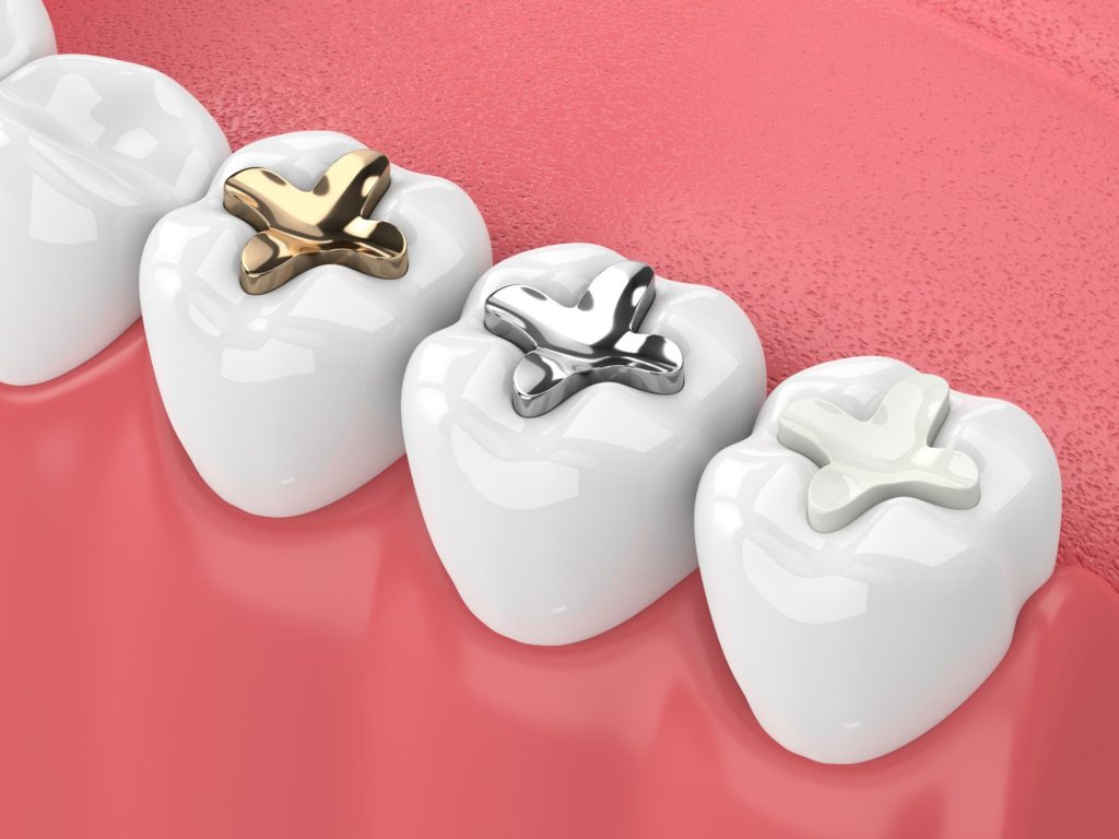 3D model of teeth with different dental fillings Towson Maryland