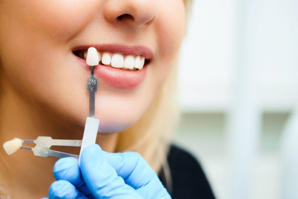 closeup image of woman smiling dental veneers dentist in Towson Maryland