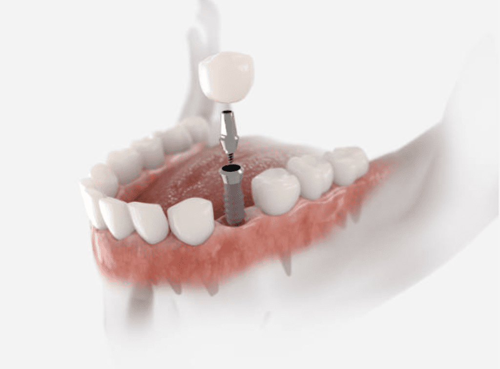 3d image of dental implant dentist in Towson Maryland