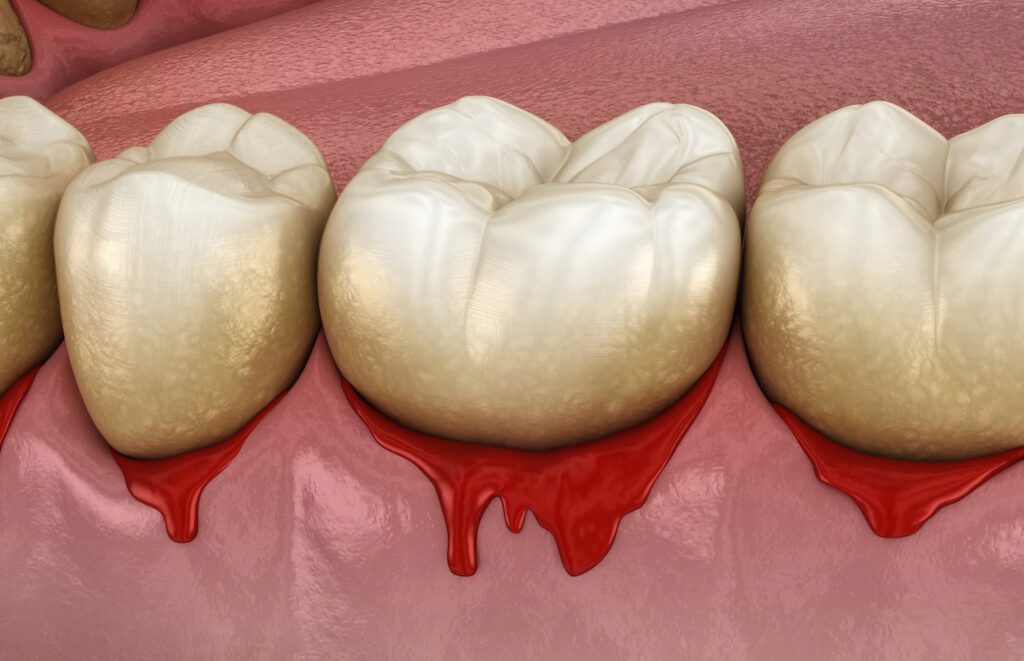 BLEEDING GUMS in TREATMENT Towson, MD could be treated with early intervention