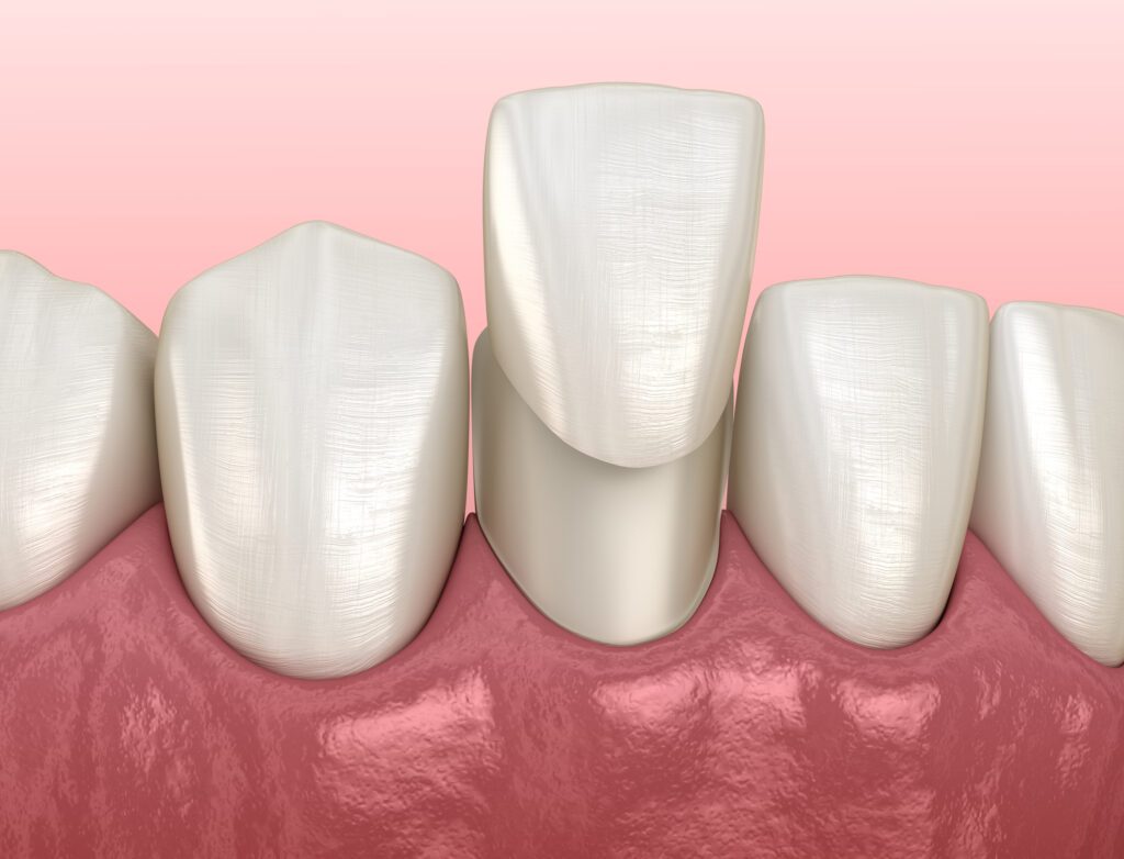 PORCELAIN VENEERS in TOWSON MD can help correct many minor imperfections in your smile