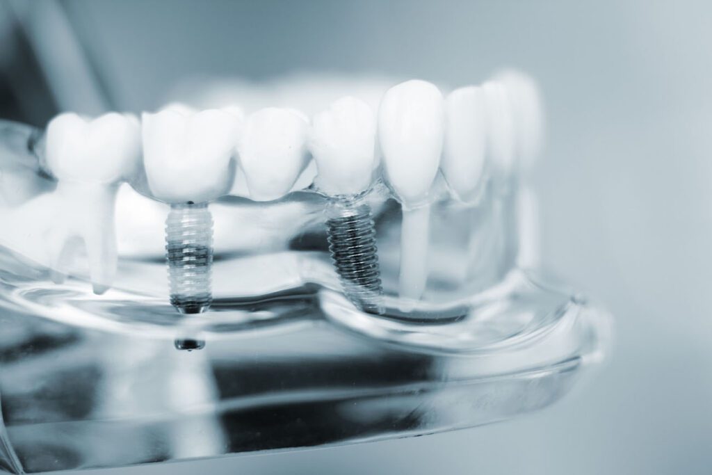 DENTAL IMPLANTS in TOWSON MD are the most recommended treatment option for patients with missing teeth