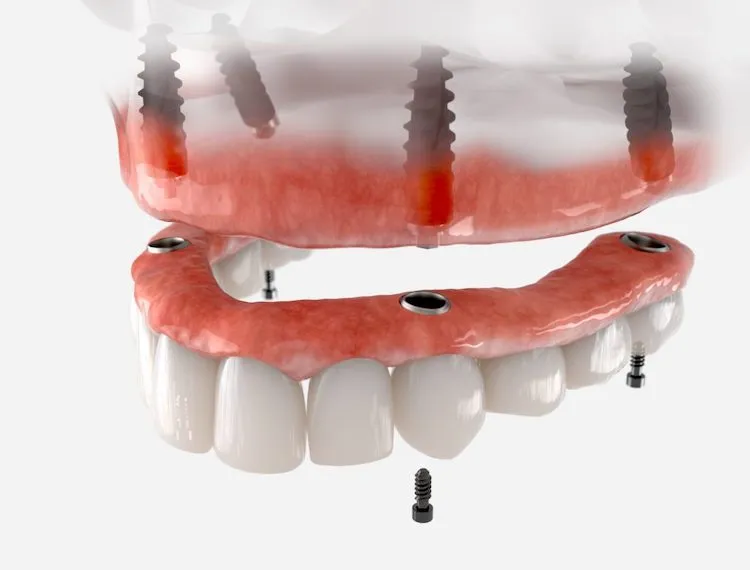 Living with Dentures? Implants Change Everything in Towson, MD